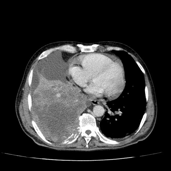 File:Non small-cell lung cancer (Radiopaedia 24467-24769 C+ delayed 42).jpg