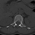 Normal CT lumbar spine (Radiopaedia 53981-60118 Axial bone window 12).jpg