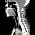 Normal CT of the neck (Radiopaedia 14575-14500 Sagittal C+ 26).jpg