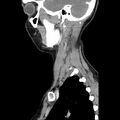 Normal CT of the neck (Radiopaedia 14575-14500 Sagittal C+ 40).jpg