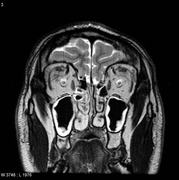 File:Normal coronal brain (Radiopaedia 6676-7910 Coronal T2 3).jpg