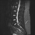 Normal lumbar spine MRI (Radiopaedia 47857-52609 Sagittal STIR 12).jpg
