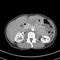 Normal multiphase CT liver (Radiopaedia 38026-39996 B 36).jpg
