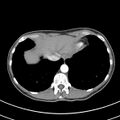 Normal multiphase CT liver (Radiopaedia 38026-39996 B 7).jpg