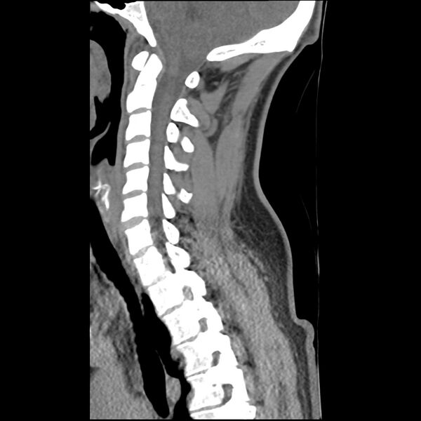 File:Normal trauma spine imaging (Radiopaedia 31753-32686 A 17).jpg