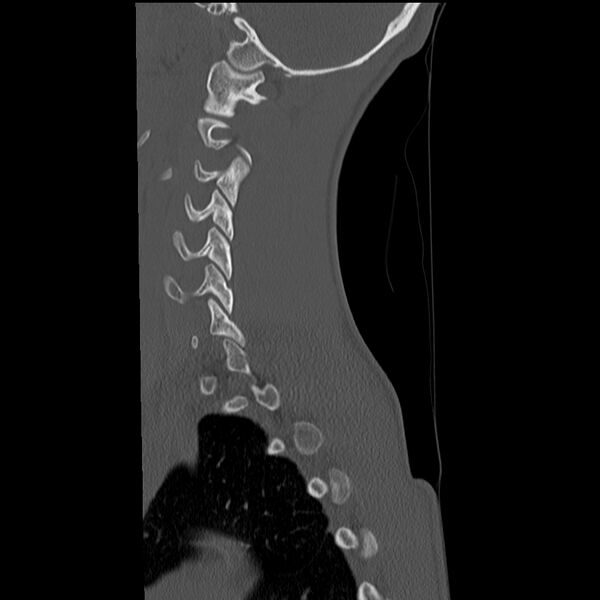 File:Normal trauma spine imaging (age 16) (Radiopaedia 45335-49358 Sagittal bone window 31).jpg