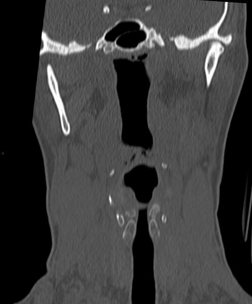 File:Occipital condyle fracture (Radiopaedia 61165-69056 Coronal bone window 16).jpg