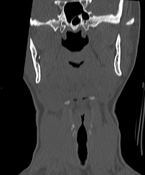 File:Occipital condyle fracture (Radiopaedia 61165-69056 Coronal bone window 18).jpg
