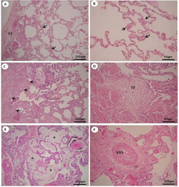 a-f) Degree of fibrosis in the pattern of usual interstitial pneumonia