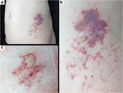 Nicolau syndrome associated subcutaneous glatiramer acetate injection[15] a) Nicolau Syndrome on left abdomen b) erythematous, purpuric and haemorrhagic patch, at site of subcutaneous glatiramer acetate c) 3 weeks after GA injection livedoid patch disappeared