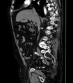 Abdominal aortic aneurysm (Radiopaedia 25855-26001 Sagittal C+ arterial phase 13).jpg