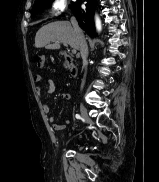 File:Abdominal aortic aneurysm (Radiopaedia 25855-26001 Sagittal C+ arterial phase 13).jpg
