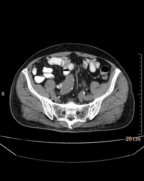 File:Abdominal aortic aneurysm (Radiopaedia 25985-26121 Axial non-contrast 24).jpg