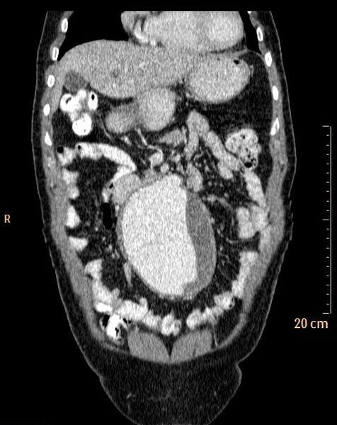 File:Abdominal aortic aneurysm (Radiopaedia 25985-26121 Coronal C+ arterial phase 5).jpg