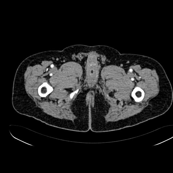 File:Abdominal aortic aneurysm (Radiopaedia 75131-86203 Axial C+ arterial phase 53).jpg