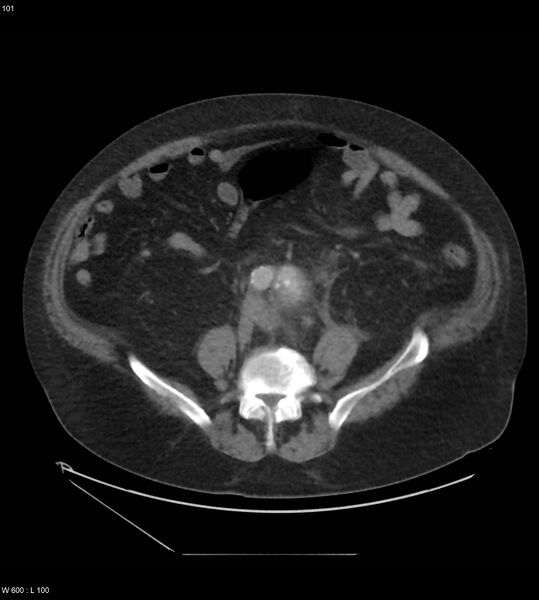 File:Abdominal aortic aneurysm with intramural hematoma then rupture (Radiopaedia 50278-55631 Axial C+ arterial phase 92).jpg