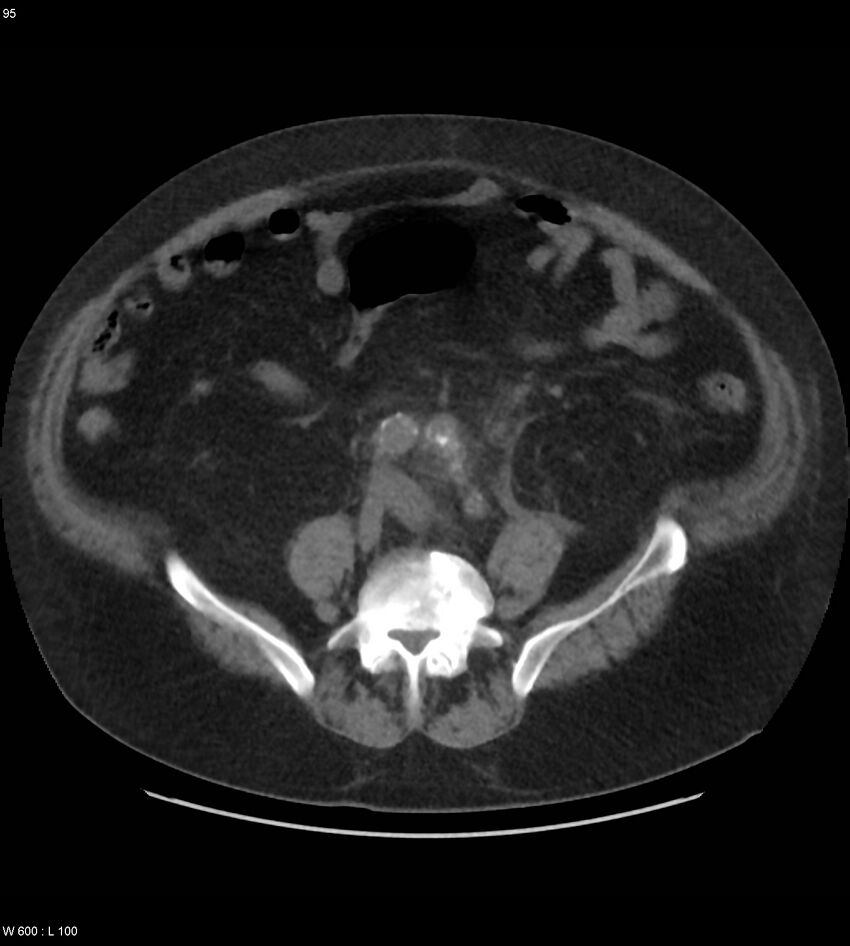 Abdominal aortic aneurysm with intramural hematoma then rupture (Radiopaedia 50278-55631 Axial non-contrast 91).jpg