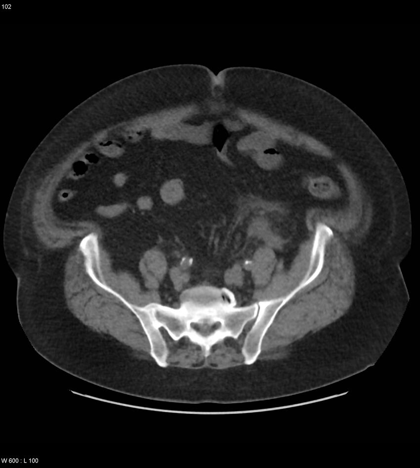 Abdominal aortic aneurysm with intramural hematoma then rupture (Radiopaedia 50278-55631 Axial non-contrast 98).jpg