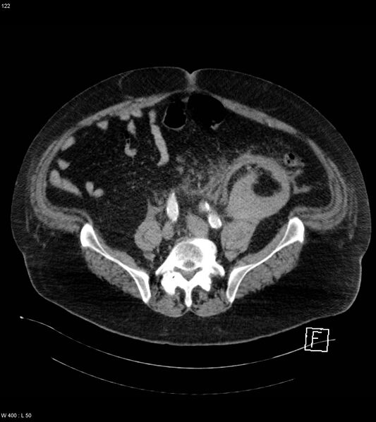 File:Abdominal aortic aneurysm with intramural hematoma then rupture (Radiopaedia 50278-55632 Axial C+ arterial phase 121).jpg