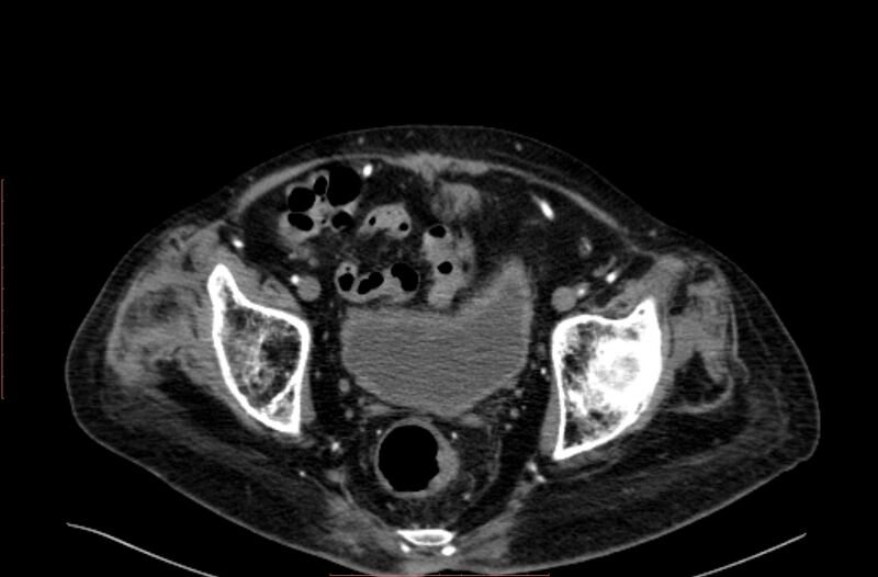 File:Abdominal aortic interposition tube graft and aneurysm thrombosis (Radiopaedia 71438-81857 Axial C+ arterial phase 211).jpg