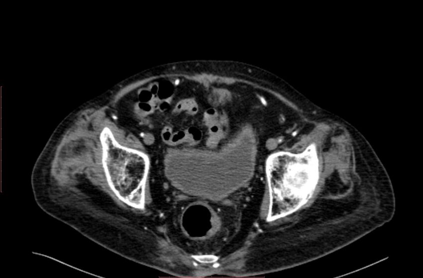 Abdominal aortic interposition tube graft and aneurysm thrombosis (Radiopaedia 71438-81857 Axial C+ arterial phase 211).jpg