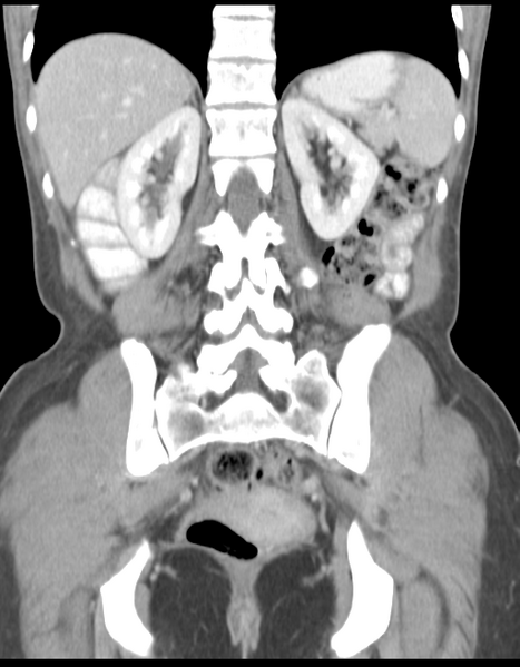 File:Abdominal desmoid tumor (Radiopaedia 41007-43740 Coronal C+ portal venous phase 29).png