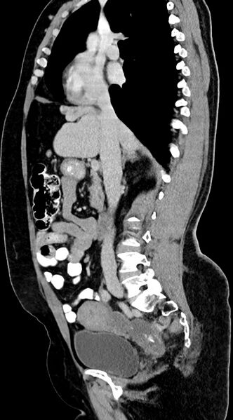 File:Abdominal hydatid disease (Radiopaedia 68223-77737 Sagittal C+ portal venous phase 41).jpg