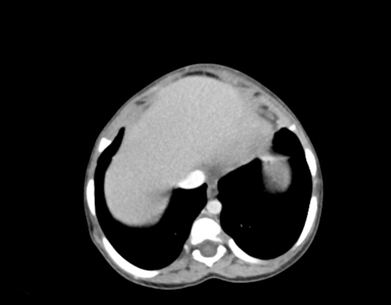 File:Abdominal premesenteric cystic lymphangioma (Radiopaedia 82995-97350 Axial C+ portal venous phase 1).jpg