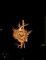 Aberrant left pulmonary artery (pulmonary sling) (Radiopaedia 42323-45435 3D reconstruction C+ CTPA 20).jpg