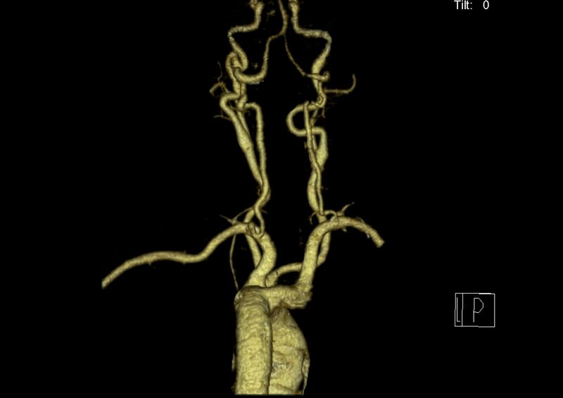 File:Aberrant right subclavian artery (Radiopaedia 19283-19294 3D reconstruction C+ arterial phase 21).jpg