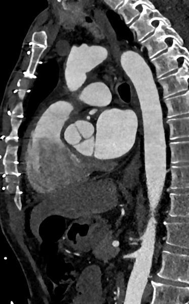 File:Accessory left atrial appendage (Radiopaedia 81987-95968 Sagittal C+ arterial phase 65).jpg
