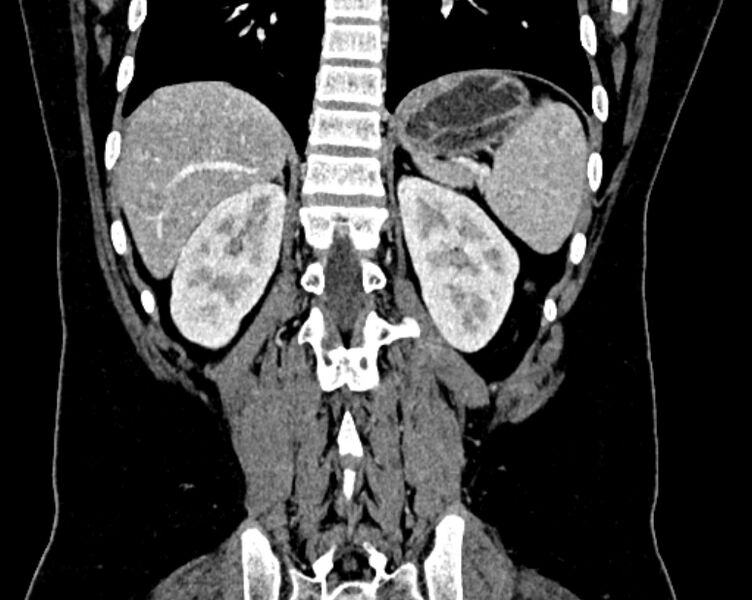 File:Accessory right inferior hepatic vein (Radiopaedia 75207-86305 Coronal C+ portal venous phase 59).jpg