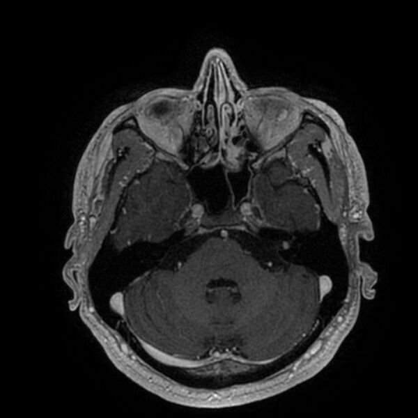 File:Acoustic schwannoma - intracanalicular (Radiopaedia 37247-39024 Axial T1 C+ 71).jpg