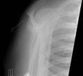 Acromioclavicular joint injury- grade 4 (Radiopaedia 49834-55104 Lateral 1).jpg