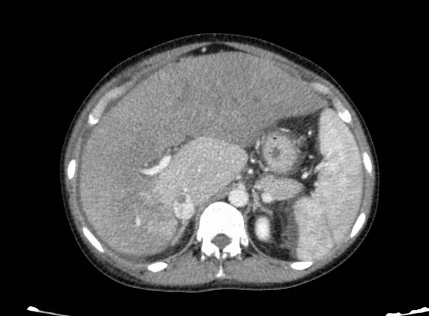 Acute Budd-Chiari syndrome (Radiopaedia 60858-68638 Axial C+ portal venous phase 90).jpg