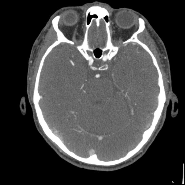 File:Acute P1 occlusion with PCA ischemia penumbra (CT perfusion) (Radiopaedia 72084-82587 Axial C+ arterial thins 56).jpg