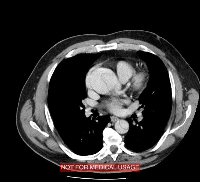 File:Acute aortic dissection - Stanford type A (Radiopaedia 40661-43285 Axial C+ portal venous phase 27).jpg