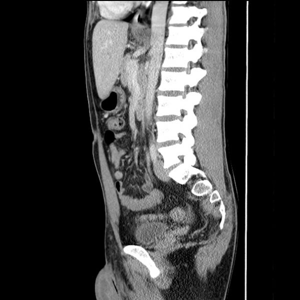 File:Acute appendicitis (Radiopaedia 27049-27227 Sagittal C+ portal venous phase 45).jpg
