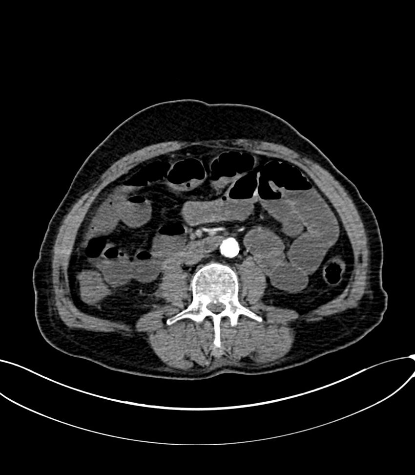 Acute arterial mesenteric ischemia (Radiopaedia 78238-90828 Axial C+ arterial phase 71).jpg