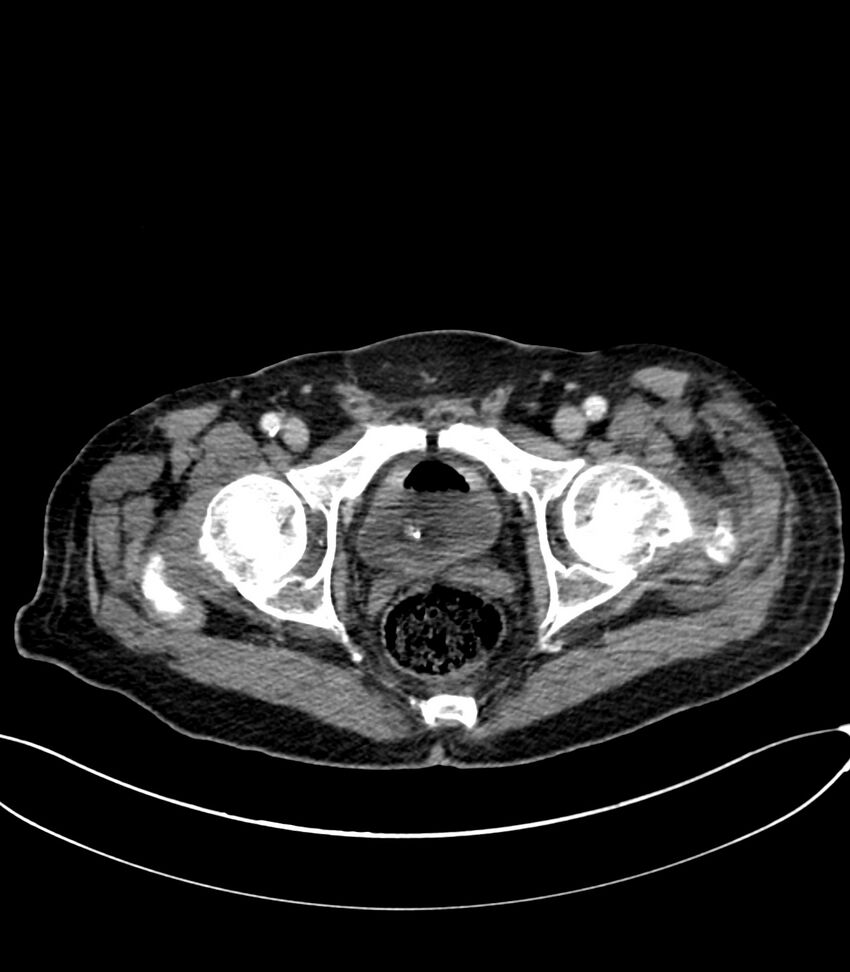 Acute arterial mesenteric ischemia (Radiopaedia 78238-90828 Axial C+ portal venous phase 135).jpg