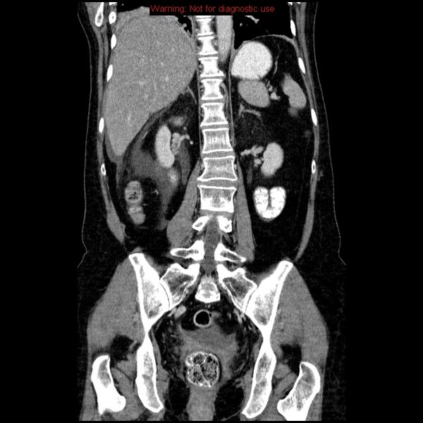 File:Acute gangrenous cholecystitis (Radiopaedia 10123-10661 Coronal C+ portal venous phase 29).jpg