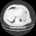 Acute heart failure (CT) (Radiopaedia 79835-93075 Axial lung window 38).png