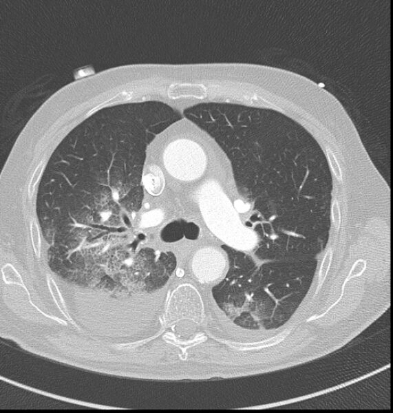 File:Acute myocardial infarction (Radiopaedia 23413-23481 lung window 16).jpg