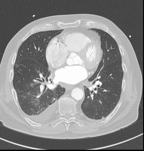 File:Acute myocardial infarction (Radiopaedia 23413-23481 lung window 40).jpg