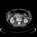 Acute myocardial infarction in CT (Radiopaedia 39947-42415 Axial C+ portal venous phase 55).jpg