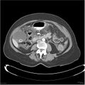 Acute pancreatitis (Radiopaedia 19136-19117 Axial C+ portal venous phase 22).jpg