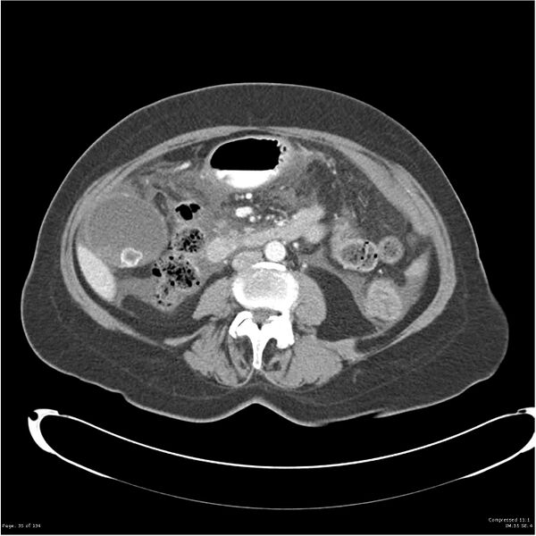 File:Acute pancreatitis (Radiopaedia 19136-19117 Axial C+ portal venous phase 22).jpg