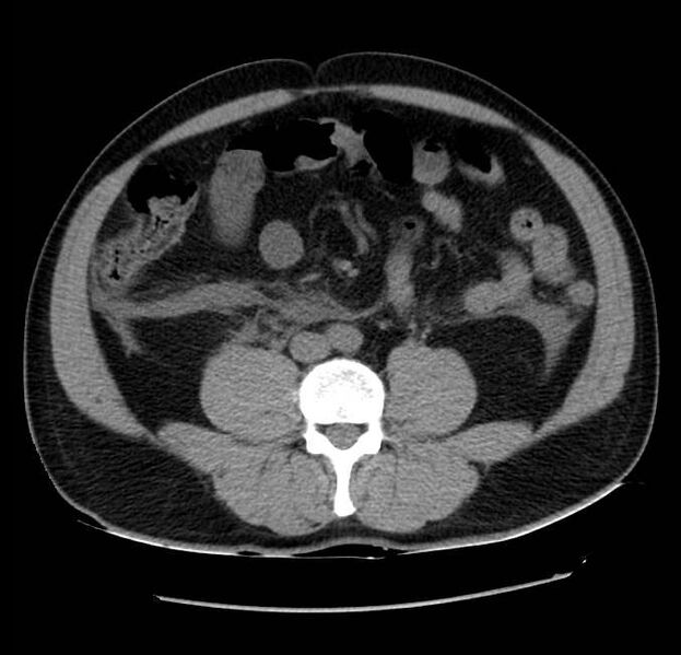 File:Acute pancreatitis - Balthazar E (Radiopaedia 23080-23110 Axial non-contrast 42).jpg