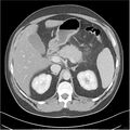 Acute pancreatitis - mild (Radiopaedia 27796-28033 C+ portal venous phase 9).jpg