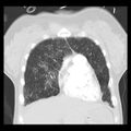 Acute pulmonary edema on CT (Radiopaedia 33582-34672 Coronal lung window 7).jpg